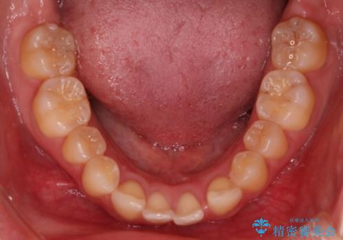 抜歯矯正×インビザライン|上下のバランスを整え、美しい歯並びへの治療前