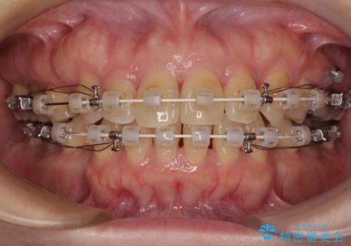 抜歯矯正 ワイヤー装置で横顔の印象を改善の治療中