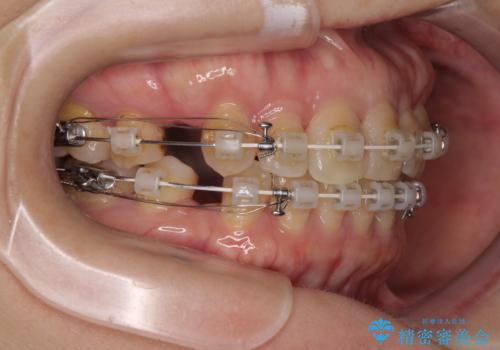 抜歯矯正 ワイヤー装置で横顔の印象を改善の治療中
