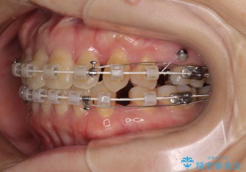 抜歯矯正 ワイヤー装置で横顔の印象を改善の治療中