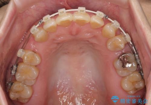 抜歯矯正 ワイヤー装置で横顔の印象を改善の治療中