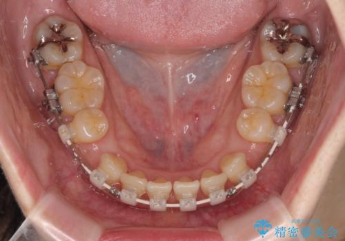 抜歯矯正 ワイヤー装置で横顔の印象を改善の治療中