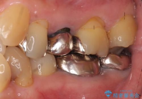 50代女性 八重歯を矯正治療 歯並びの中等度のがたつきの治療前