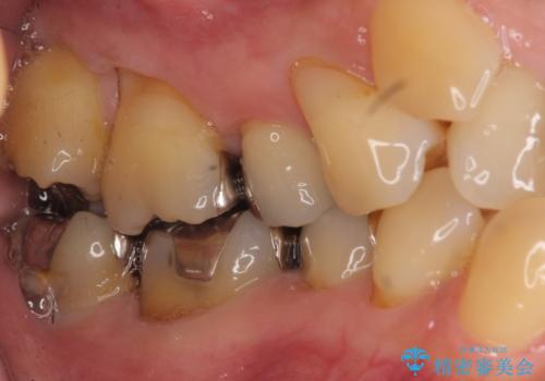 50代女性 八重歯を矯正治療 歯並びの中等度のがたつきの治療前