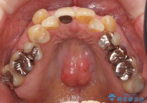 50代女性 八重歯を矯正治療 歯並びの中等度のがたつきの治療前