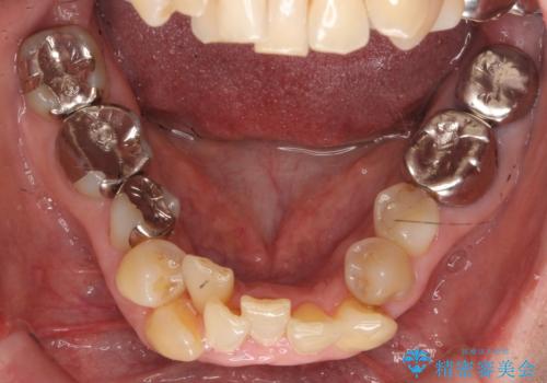 50代女性 八重歯を矯正治療 歯並びの中等度のがたつきの治療前