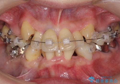 50代女性　八重歯を矯正治療　歯並びの中等度のがたつきの治療中