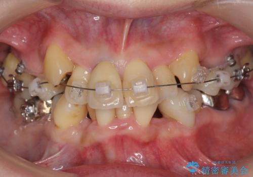 50代女性 八重歯を矯正治療 歯並びの中等度のがたつきの治療中