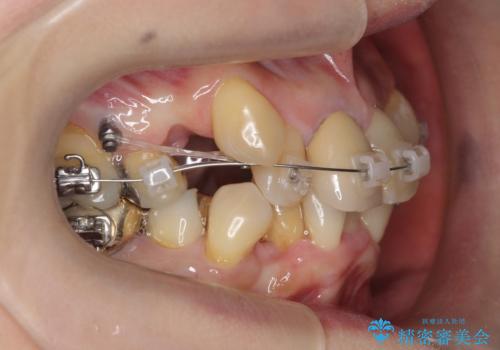 50代女性 八重歯を矯正治療 歯並びの中等度のがたつきの治療中
