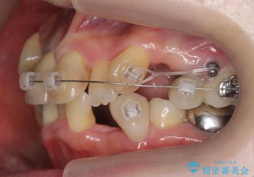 50代女性 八重歯を矯正治療 歯並びの中等度のがたつきの治療中