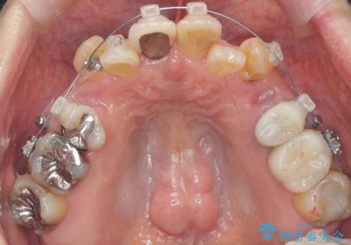 50代女性 八重歯を矯正治療 歯並びの中等度のがたつきの治療中