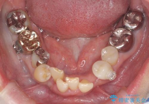 50代女性 八重歯を矯正治療 歯並びの中等度のがたつきの治療中