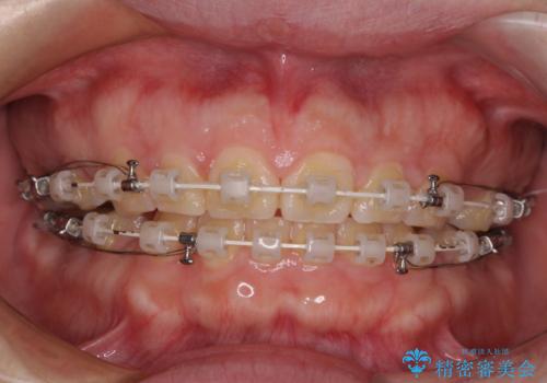 口元の突出感を治したい ワイヤー装置を用いた抜歯矯正の治療中