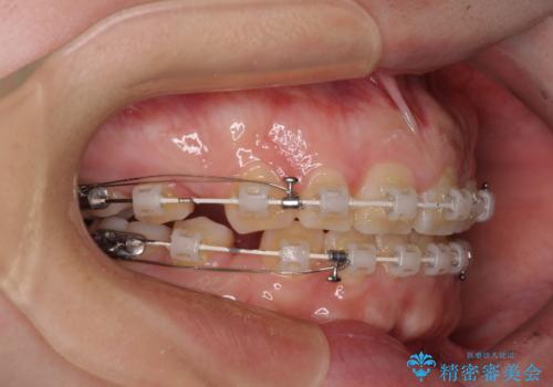 口元の突出感を治したい ワイヤー装置を用いた抜歯矯正の治療中