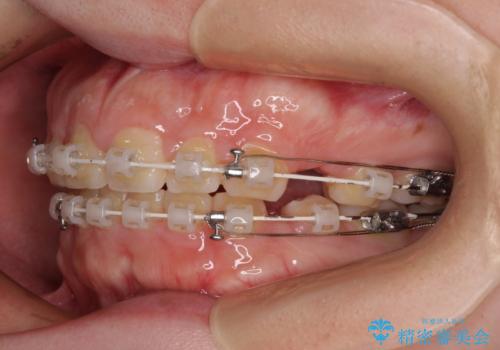 口元の突出感を治したい ワイヤー装置を用いた抜歯矯正の治療中