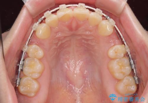口元の突出感を治したい ワイヤー装置を用いた抜歯矯正の治療中