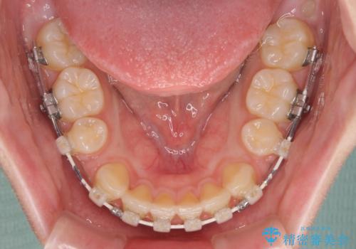 口元の突出感を治したい ワイヤー装置を用いた抜歯矯正の治療中