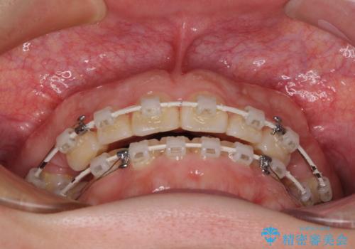 口元の突出感を治したい ワイヤー装置を用いた抜歯矯正の治療中