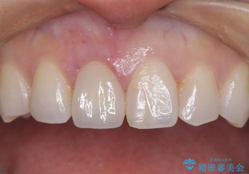 根管治療と並行して矯正を マウスピース治療の治療後