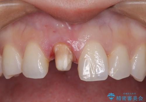 根管治療と並行して矯正を マウスピース治療の治療中