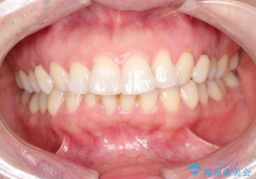 審美装置を用いたワイヤー矯正|非抜歯で歯の凸凹を改善