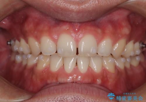 前歯の隙間が気になる マウスピース矯正の治療中