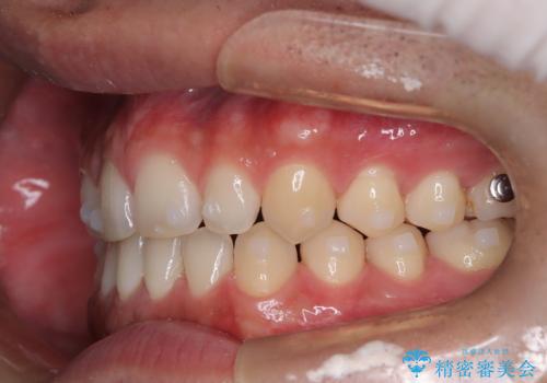 前歯の隙間が気になる マウスピース矯正の治療中