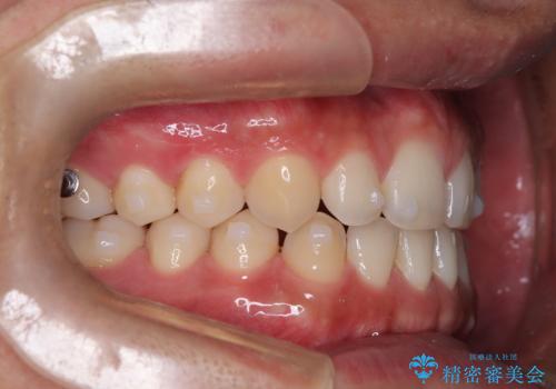 前歯の隙間が気になる マウスピース矯正の治療中
