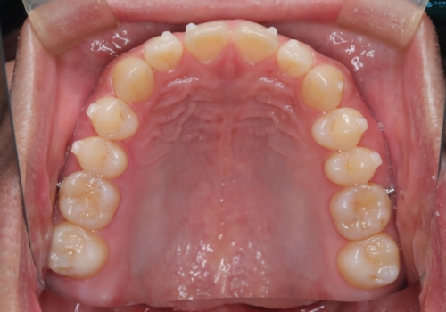 前歯の隙間が気になる マウスピース矯正の治療中
