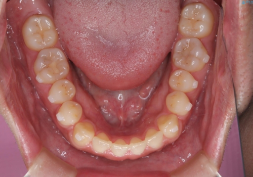 前歯の隙間が気になる マウスピース矯正の治療中