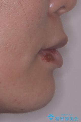 口元の突出感を改善したい。審美装置による抜歯矯正の治療後(顔貌)