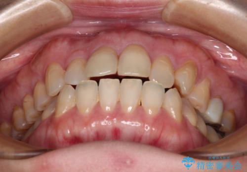 抜歯矯正 ワイヤー装置で横顔の印象を改善の治療前