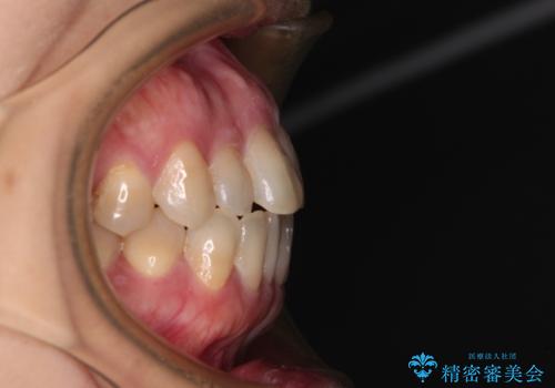 抜歯矯正 ワイヤー装置で横顔の印象を改善の治療前