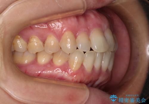 抜歯矯正 ワイヤー装置で横顔の印象を改善の治療前