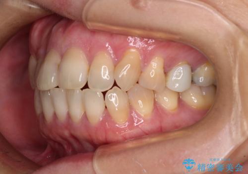 抜歯矯正 ワイヤー装置で横顔の印象を改善の治療前