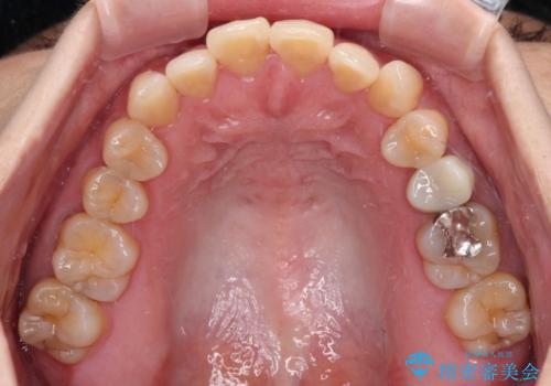 抜歯矯正 ワイヤー装置で横顔の印象を改善の治療前