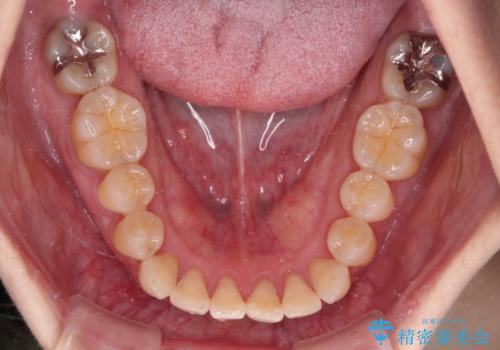 抜歯矯正 ワイヤー装置で横顔の印象を改善の治療前