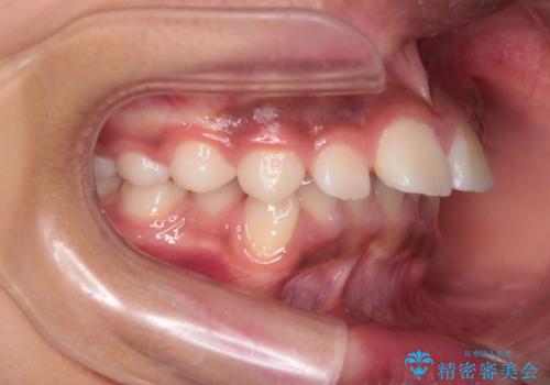 前歯の突出を抜歯なしで改善|リンガルアーチ×TADを活用した矯正治療の治療前