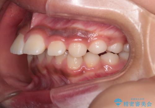 前歯の突出を抜歯なしで改善|リンガルアーチ×TADを活用した矯正治療の治療前
