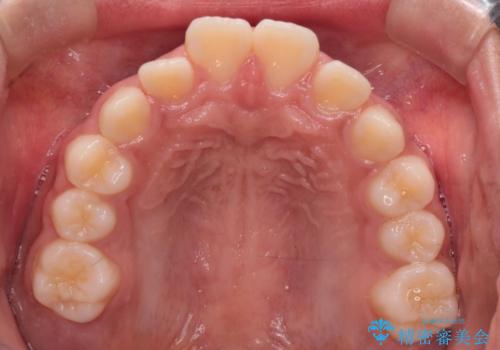 前歯の突出を抜歯なしで改善|リンガルアーチ×TADを活用した矯正治療の治療前