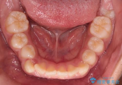 前歯の突出を抜歯なしで改善|リンガルアーチ×TADを活用した矯正治療の治療前