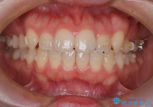 インビザライン×ワイヤー矯正の併用で理想の歯並びへ|MTMで小臼歯のねじれも改善の治療中