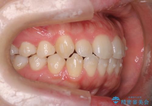 インビザライン×ワイヤー矯正の併用で理想の歯並びへ|MTMで小臼歯のねじれも改善の治療中