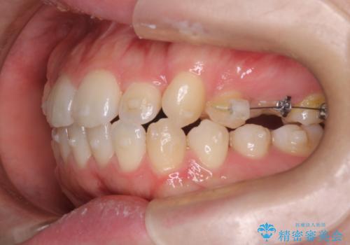 インビザライン×ワイヤー矯正の併用で理想の歯並びへ|MTMで小臼歯のねじれも改善の治療中