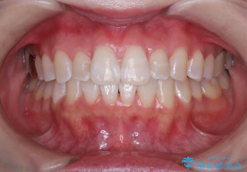 初めてのオフィスホワイトニングの症例 治療後
