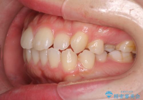 インビザライン×ワイヤー矯正の併用で理想の歯並びへ|MTMで小臼歯のねじれも改善の治療前