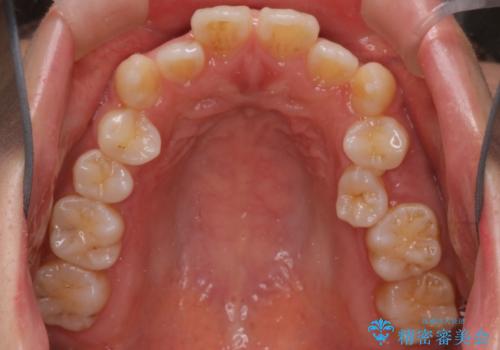 インビザライン×ワイヤー矯正の併用で理想の歯並びへ|MTMで小臼歯のねじれも改善の治療前