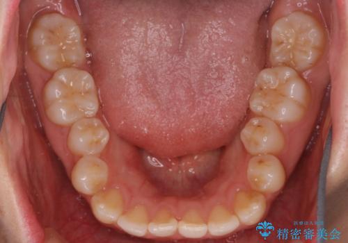 インビザライン×ワイヤー矯正の併用で理想の歯並びへ|MTMで小臼歯のねじれも改善の治療前