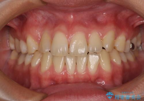 マウスピース矯正が煩わしい ワイヤー装置での非抜歯矯正