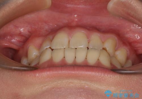 マウスピース矯正が煩わしい ワイヤー装置での非抜歯矯正の治療前